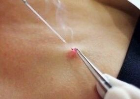 Laser eemaldamine