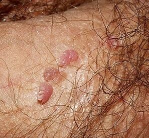 Papilloomid peenisel