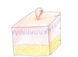 kuidas vabaneda papilloomidest kehal