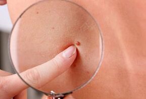 papilloomide ilmnemise põhjused inimkehale