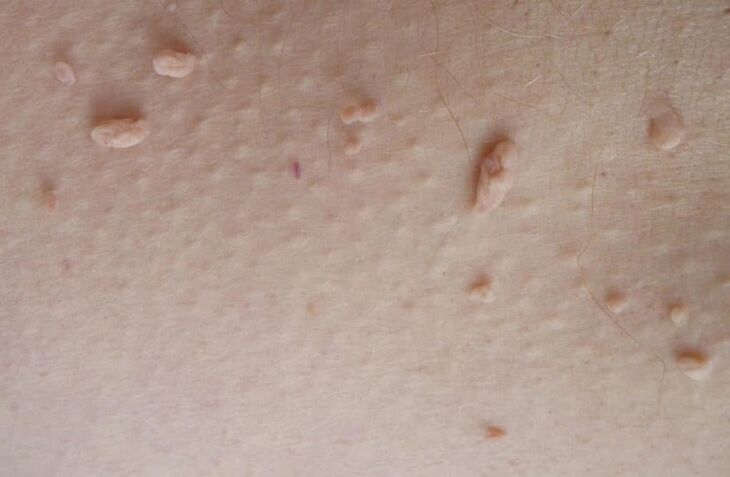 filamentsed papilloomid nahal
