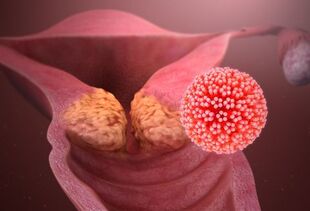 millised haigused põhjustavad HPV-d